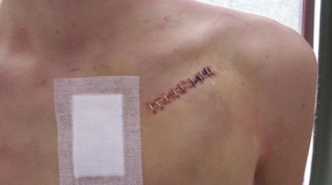 Pacemaker_wound